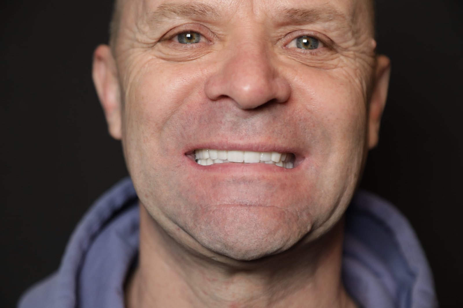 Hollywood Smile Örnek Görsel